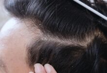 Photo of What Is The Best Way To Get Rid Of Dandruff In Men’s Hair?