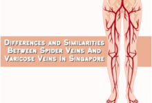 Photo of Getting To Know Varicose Veins And Spider Veins In Singapore