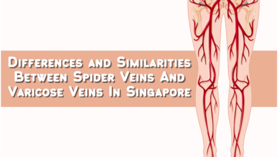 Photo of Getting To Know Varicose Veins And Spider Veins In Singapore